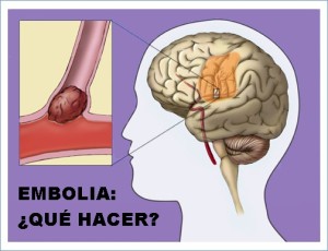 embolia-1